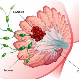 Breast Cancer and German New Medicine Breast Cancer and German New Medicine