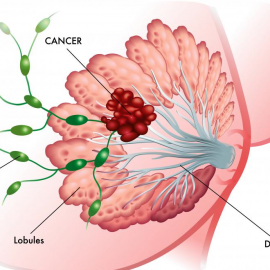 Breast Cancer and German New Medicine