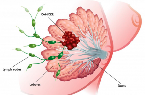 Breast Cancer and German New Medicine Teachers