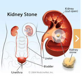 Kidneys Stones and German New Medicine (GNM)