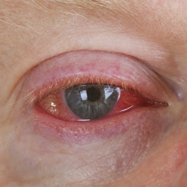 Conjunctivitis (Pink eye).