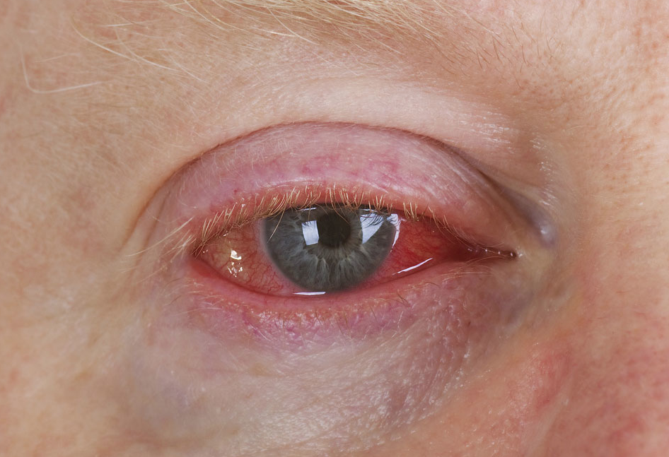 Conjunctivitis (pink eye). GNM Practitioner.
