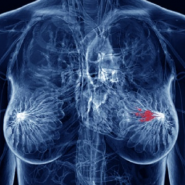 A New Light on Breast Cancer.