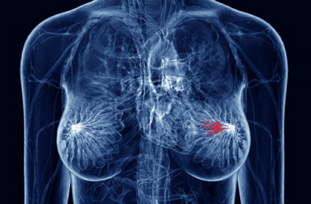 A New Light on Breast Cancer.