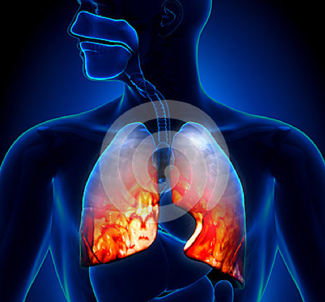 Bronchitis & Pneumonia