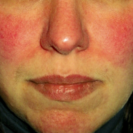 Rosacea