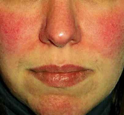 Rosacea