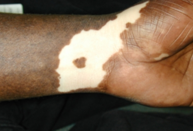 Vitiligo 1