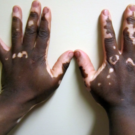 Vitiligo